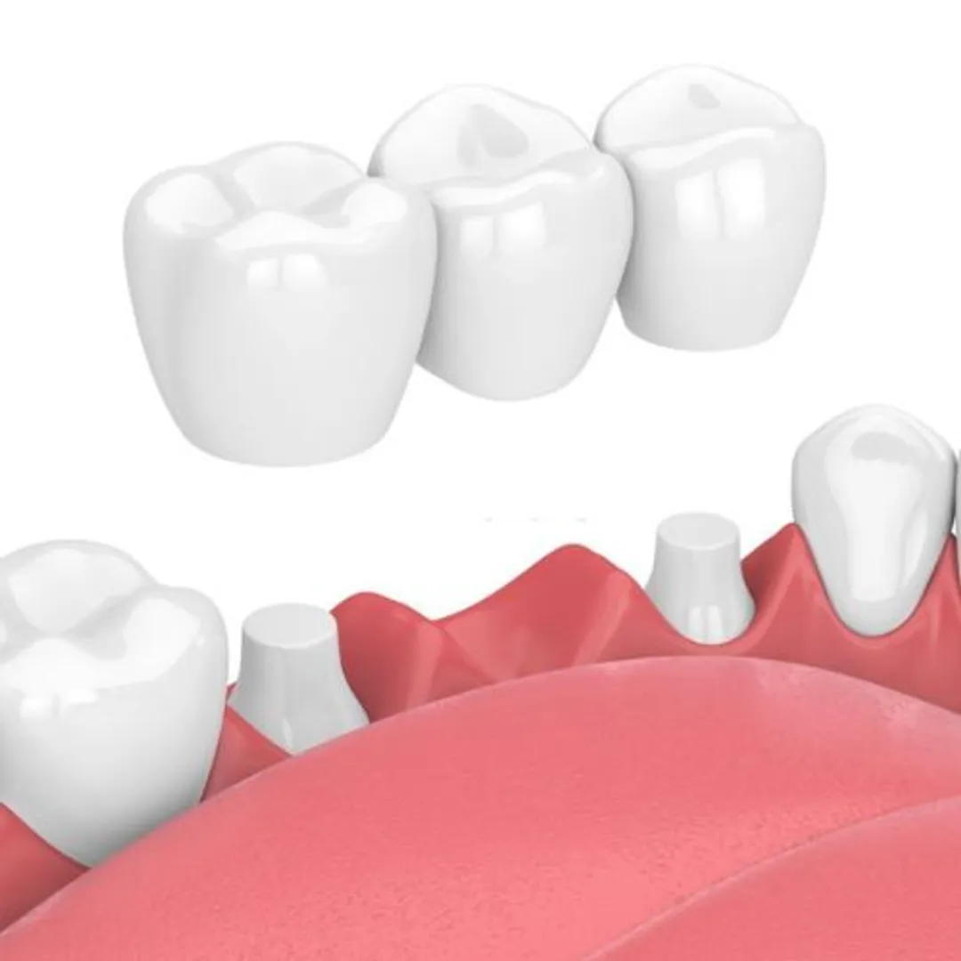 Làm cầu răng sứ có tốt không với có những loại nào
https://ubndquetho.gov.vn/new/page/Lam-cau-rang-su-co-tot-khong-voi-co-nhung-loai-nao.html
Mất răng có rất nhiều nguyên nhân và nhìn chung mất răng gây nên nhiều hậu quả ảnh hưởng đến thẩm mỹ lẫn chức năng răng miệng. Thế nên, sau mất răng, việc phục hình răng mất vô cùng quan trọng. 