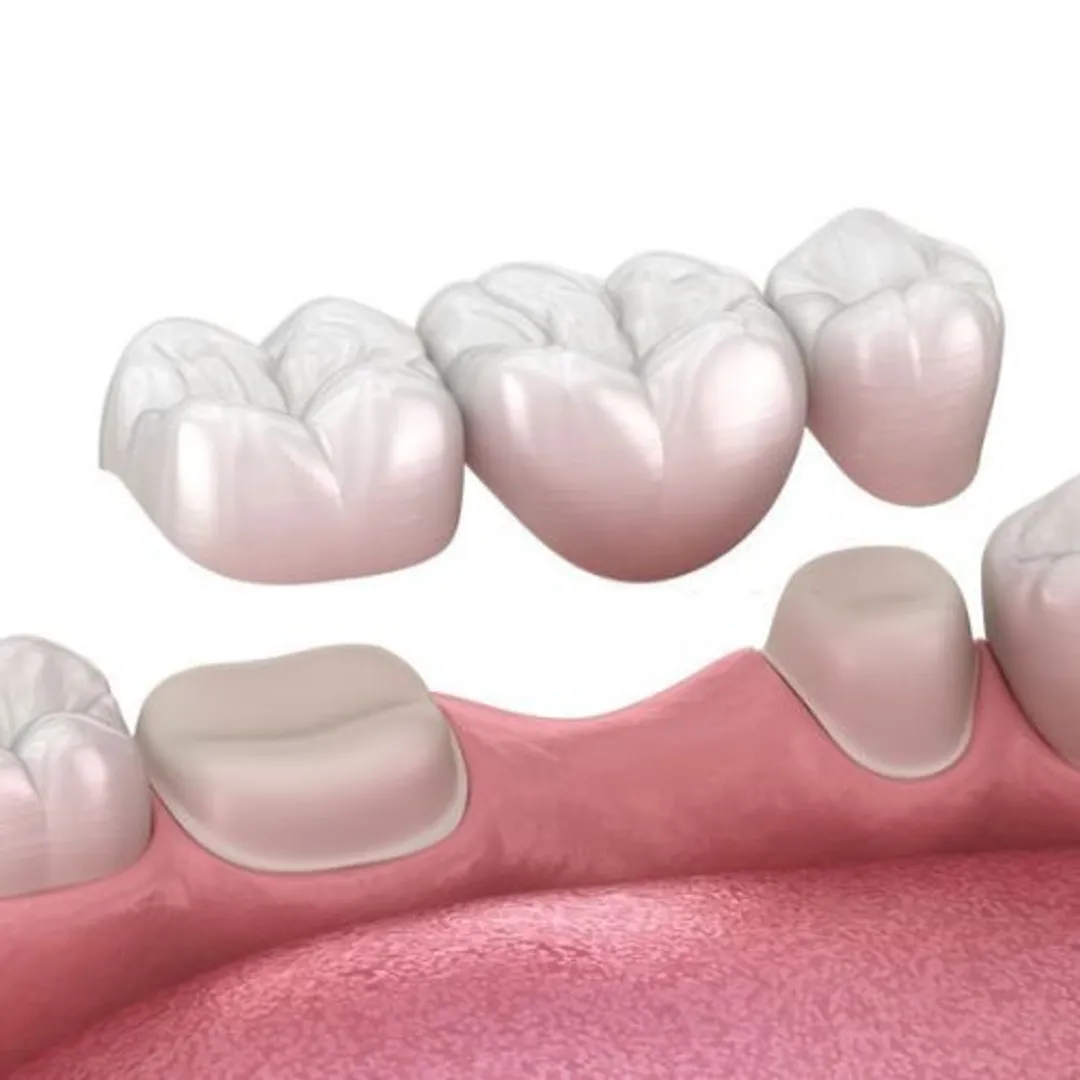 Làm cầu răng sứ có bền không Yếu tố nào quyết định
https://tragiang.gov.vn/page/Lam-cau-rang-su-co-ben-khong-Yeu-to-nao-quyet-dinh.html	
Cầu răng sứ là một giải pháp phục hình răng cải thiện thẩm mỹ và chức năng cho răng khá tốt. Đây là phương pháp được nhiều người áp dụng hiện nay khi mất răng. Tuy nhiên, vẫn có khá nhiều thắc mắc về việc làm cầu răng sứ có bền không?