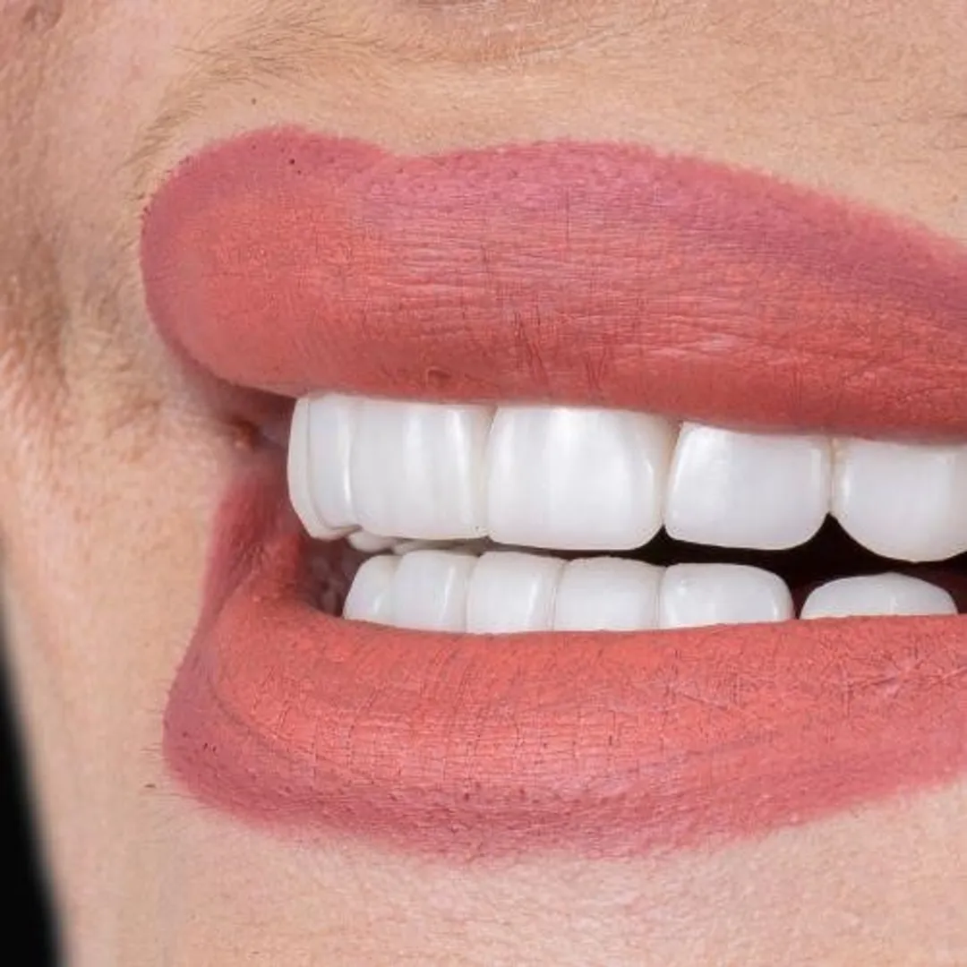 Làm răng sứ đẹp - Chọn nha khoa là yếu tố tiên quyết
https://baoquangnam.vn/ban-can-biet/lam-rang-su-dep-chon-nha-khoa-la-yeu-to-tien-quyet-147796.html
Làm răng sứ đẹp mang đến nhiều lợi ích từ thẩm mỹ, tự nhiên và nâng tầm nụ cười. Để có răng sứ đẹp phải hội tụ nhiều yếu tố, nha khoa uy tín là yếu tố tiên quyết.